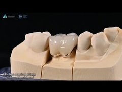 Couleur naturelle des dents, placage en céramique feldspathique pour les dents antérieures et postérieures