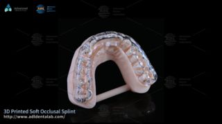 Attelle imprimée en 3D personnalisée pour le confort du bruxisme