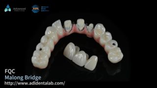Implant hybride Malo Bridge Secure Smile