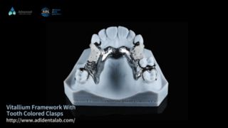 Vitallium Framework Esthétique Naturelle Ajustement Facile