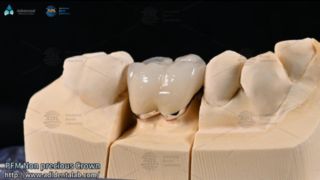 Guide de relooking du sourire naturel des facettes feldspathiques