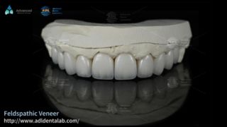 Facettes en céramique feldspathique à haute translucidité pour les sourires