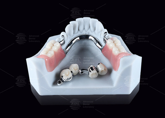 acheter CEKA M2 accrochage de précision en titane avec 3 mm de dégagement horizontal / vertical fabrication en ligne