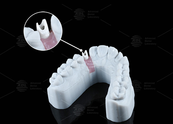 acheter Abutment en zirconium blanc personnalisé d'aspect naturel esthétique et fonctionnalité optimale fabrication en ligne