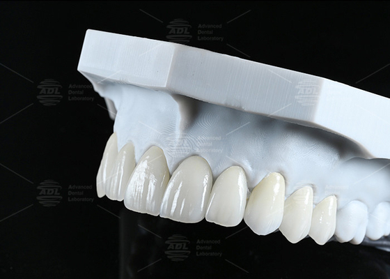 Translucide CAD EMAX Veneur Polissé Réparations en céramique vitrée pour les zones antérieures et postérieures