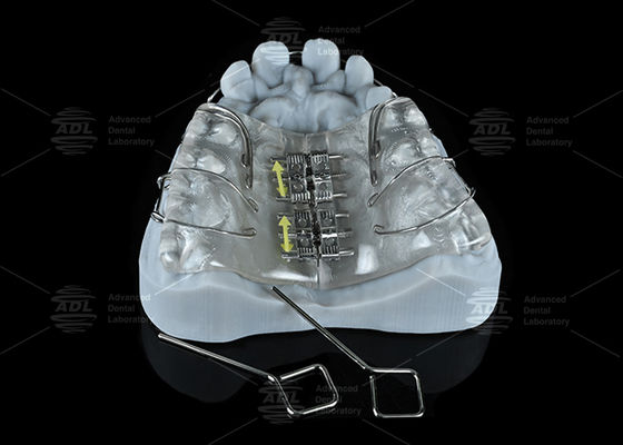 Expander à vis coloré en acier inoxydable pour laboratoire dentaire pour l'expansion maxillaire et mandibulaire