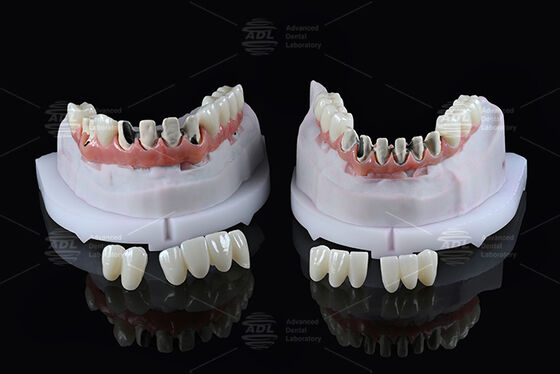 Chine Laboratoire dentaire Titane Full Arch Hybrid Bridge avec chargement immédiat A1 Shade Malong Design vis retenue Cad/Cam